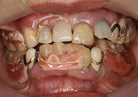 一般歯科治療 治療前