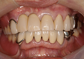 一般歯科治療 治療後