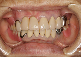 一般歯科治療 10年後